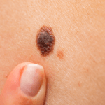 Quins són els símptomes del melanoma?