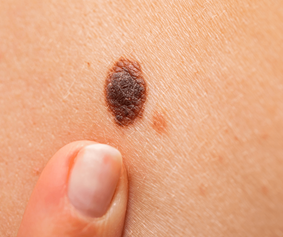 Més informació sobre l'article Quins són els símptomes del melanoma?